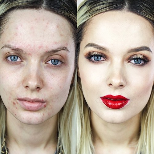 Il caso Emma Ford: quando l'acne diventa social.
