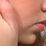 Melasma Melasma