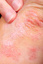 psoriasi
