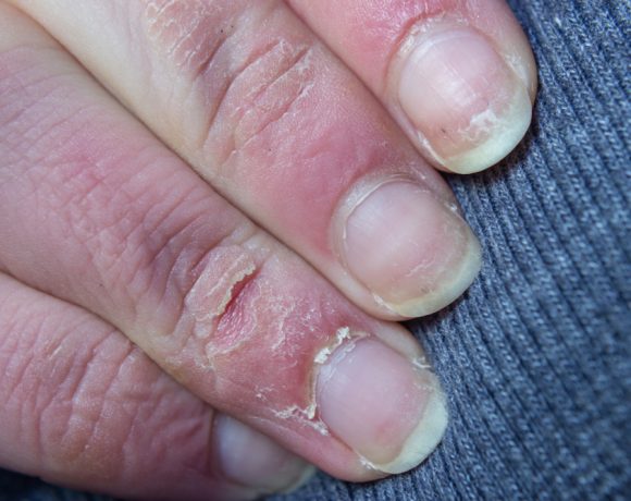 Quando la pelle di mani e piedi si fessurizza e screpola bisogna trovare un rimedio per i geloni