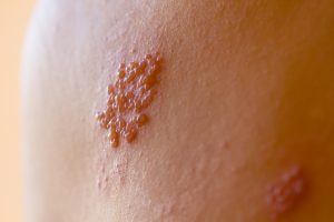 Come riconoscere l'herpes zoster dai sintomi più tipici sulla pelle