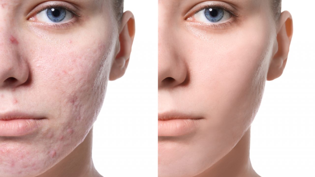 trattamenti per macchie da acne