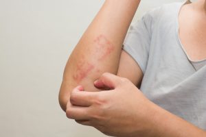 Rossori e pruriti localizzati sono i sintomi tipici dell'eczema allergico