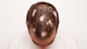alopecia areata cause e rimedi