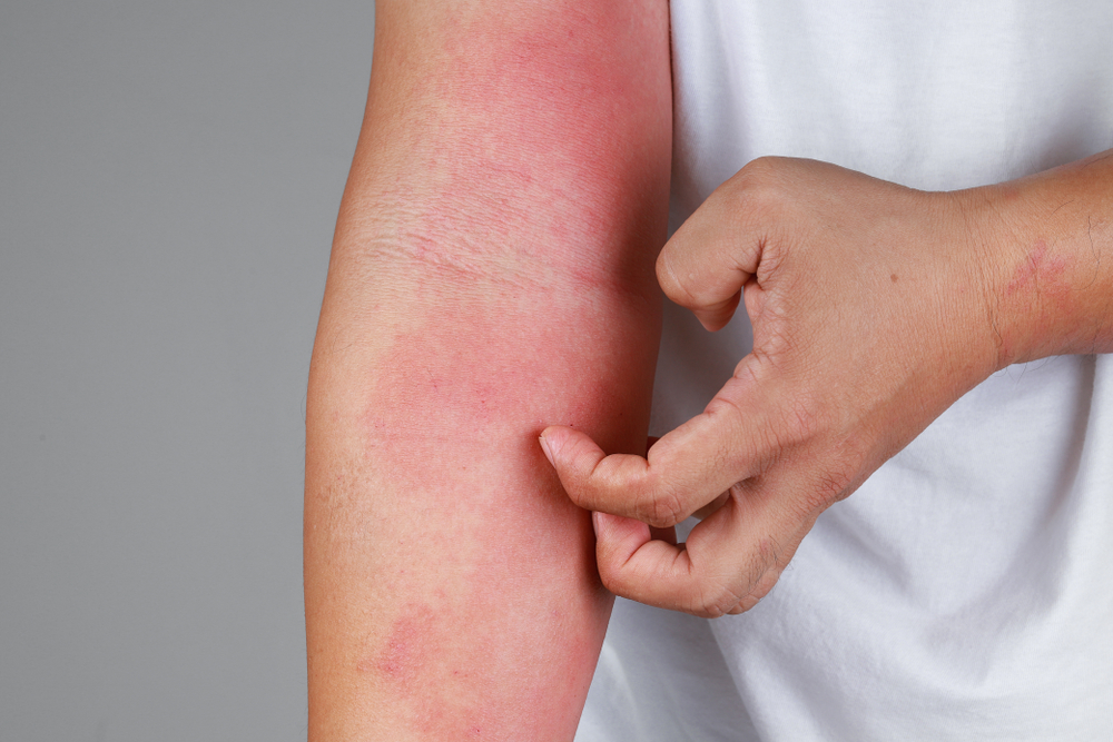 La dermatite allergica si riconosce da macchie rosse e prurito nel punto in cui la pelle è entrata a contatto con le sostanze a cui siamo allergici