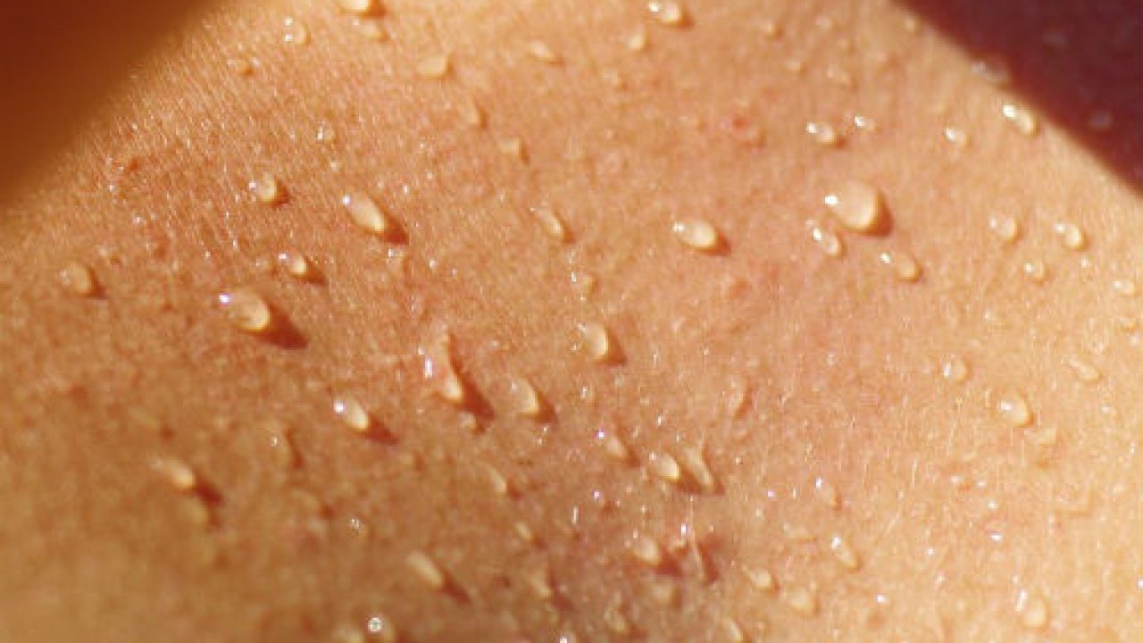 irritazione della pelle da sudore