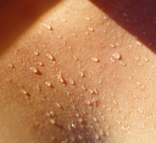 la dermatite da sudore può generare fastidiose irritazioni con brufoli o bolle: ecco come prevenirle e curarle