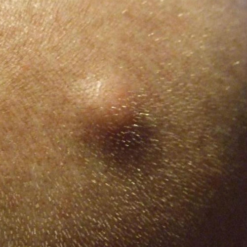 Palline Dure Sotto Pelle Si Tratta Sempre Di Cisti Prof