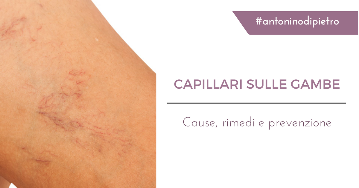 Capillari Sulle Gambe Cause Cure E Prevenzione Prof Antonino Di Pietro Capillari Sulle Gambe Cause Cure E Prevenzione Prof Antonino Di Pietro