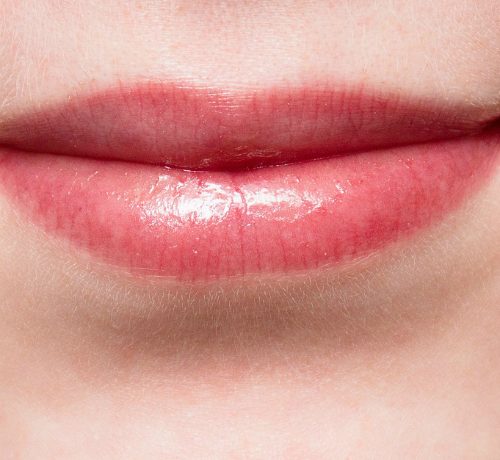 Ecco come curare la febbre sulle labbra