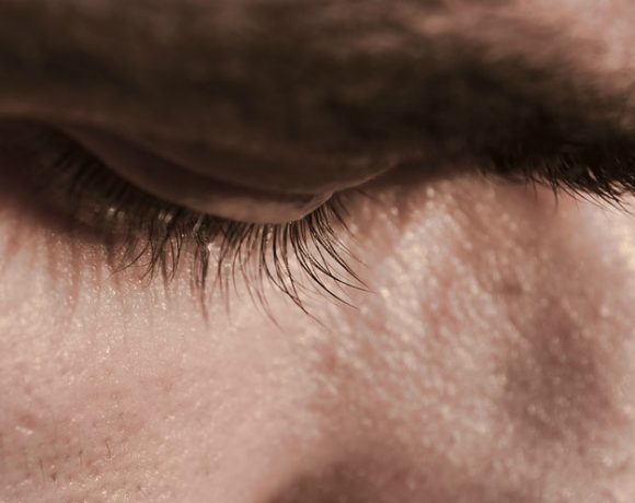 Come Faccio A Sapere Se Ho Avuto La Varicella