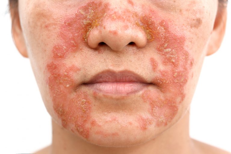 Dermatite seborroica sintomi, cura e prevenzione Prof. Antonino Di