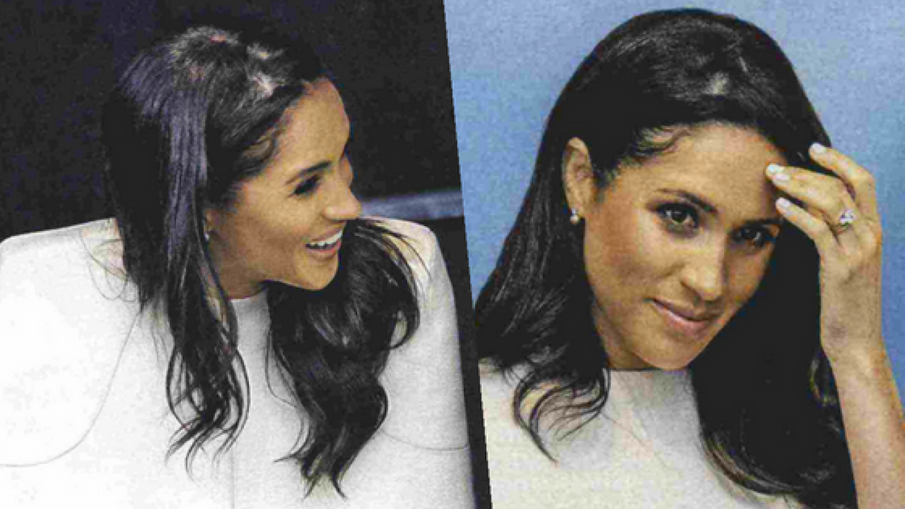 Alopecia Areata Lo Stress Di Meghan Markle Prof Antonino Di Pietro