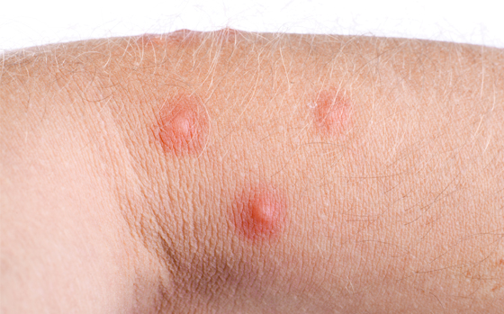 Rash cutanei da acari: come riconoscerli e trattarli | Prof. Antonino ...