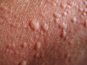 È importante curare un rash cutaneo per evitare che evolva in una forma di dermatite da contatto