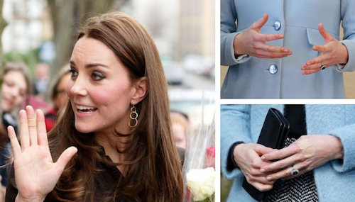 Kate Middleton malata? Ecco i cerotti sulle mani: è forse psoriasi?