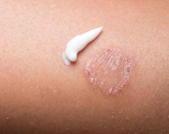 Come avviene il contagio da streptococco che causa l'erisipela e quali sono i rimedi alle macchie rosse sulla pelle