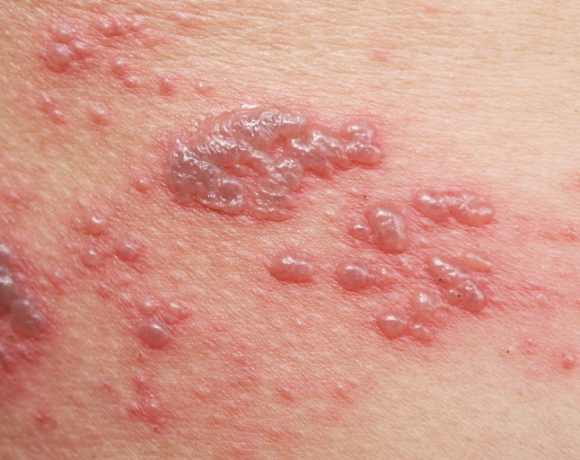 Come riconoscere una reazione allergica della pelle ai farmaci e come curarla