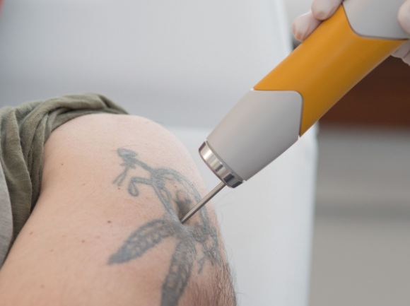 Quali risultati è possibile aspettarsi dalla rimozione laser di un tatuaggio e quante sedute sono necessarie