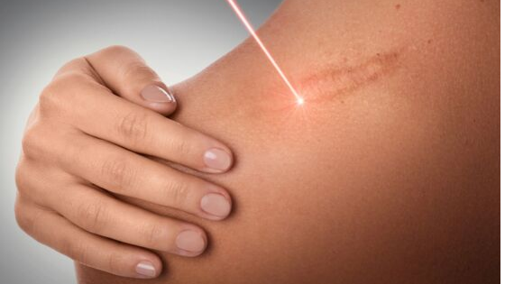 Il laser è un'ottima risorsa per attenuare le cicatrici di tipo cheloide, consigliata dai dermatologi