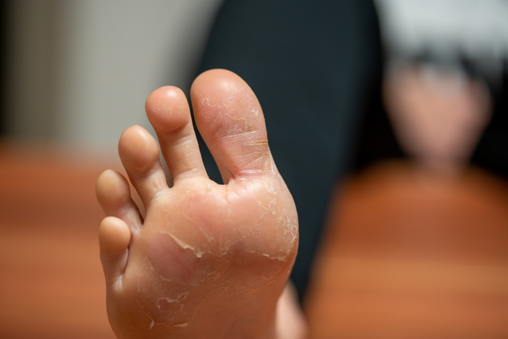 Eczema disidrosico come riconoscerlo e curarlo Prof. Antonino di Pietro