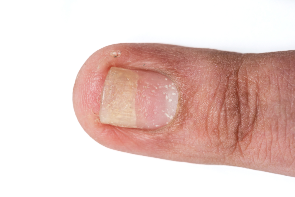 Phon asciugacapelli 1929 puttnam topical bigodino hairdressing Psoriasi delle unghie: riconoscerla e combatterla | Prof. Antonino di