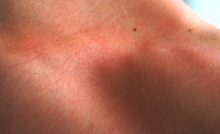 Macchie Bianche Sulla Pelle E Ipomelanosi Guttata Prof Antonino Di Pietro