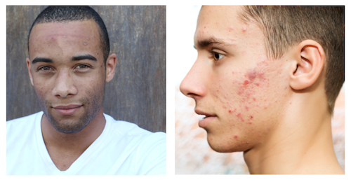 Sintomi acne uomo: adulto e adolescente
