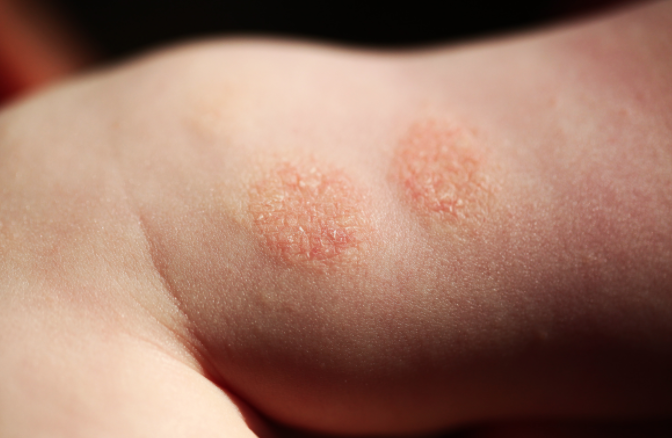 Dermatite atopica: quali sono i sintomi